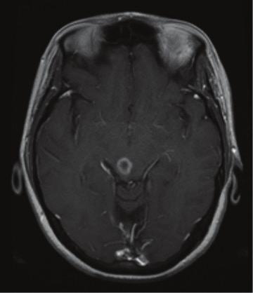 138 New Approaches to the Management of Primary and Secondary CNS Tumors Figure 5. Gadolinium contrast-enhanced T1 MRI of incidentally found midbrain lesion.