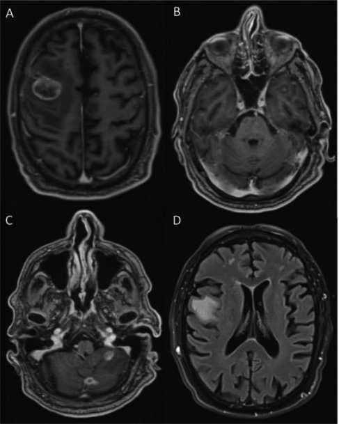Current Management of Brain Metastases: Overview and Teaching Cases http://dx.doi.org/10.5772/66310 139 Figure 6.