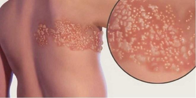 Shingles is not spread through coughing or sneezing but through direct contact with fluid from the blisters.