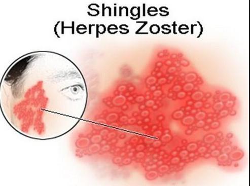 Approximately 25% of people develop shingles during their lifetime, with the majority of cases occurring in