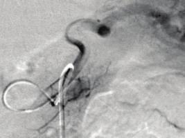 (c) A digital subtraction angiography with the catheter positioned in the proximal splenic artery, showing nodular vascularization from the arteria pancreatica magna (red arrow).