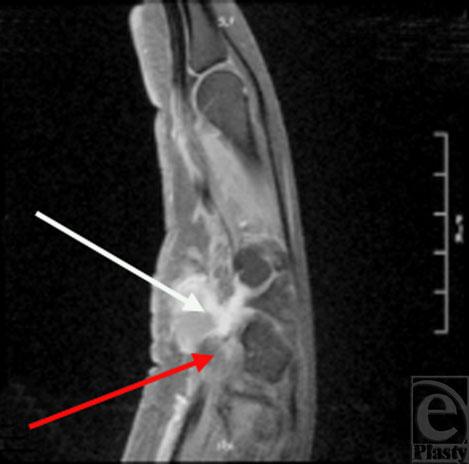 eplasty VOLUME 9 muscles innervated by the ulnar nerve. 12 We present a case of ulnar tunnel syndrome caused by a localized GCTTS of the hypothenar eminence.
