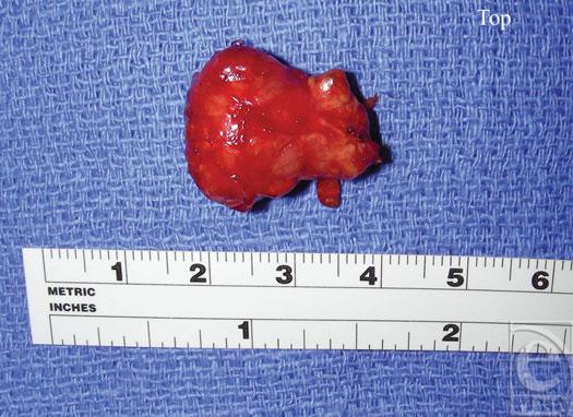 eplasty VOLUME 9 Figure 3. The removed mass. Figure 4. The patient s hand postoperatively.