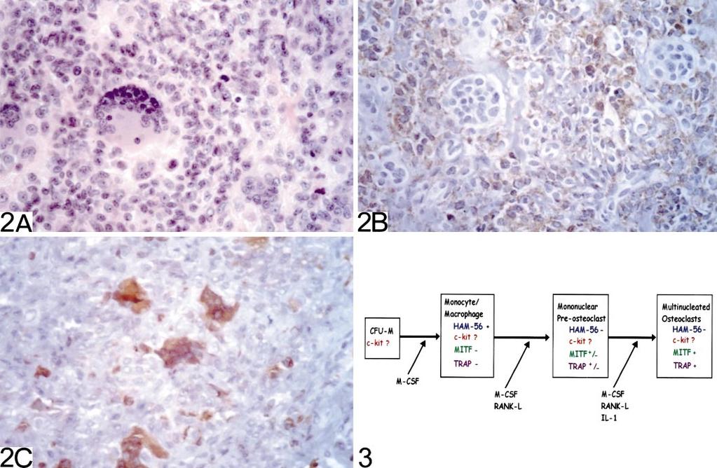 Figure 2. Localized giant cell tumor of tendon sheath (GCTTS). A, Multinucleated giant cells (GCs) and mononuclear cells (hematoxylin-eosin, original magnification ).