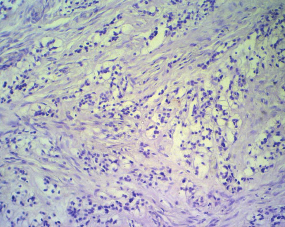 prominent cler-cell rrnged in pseudoglndulr mnner.
