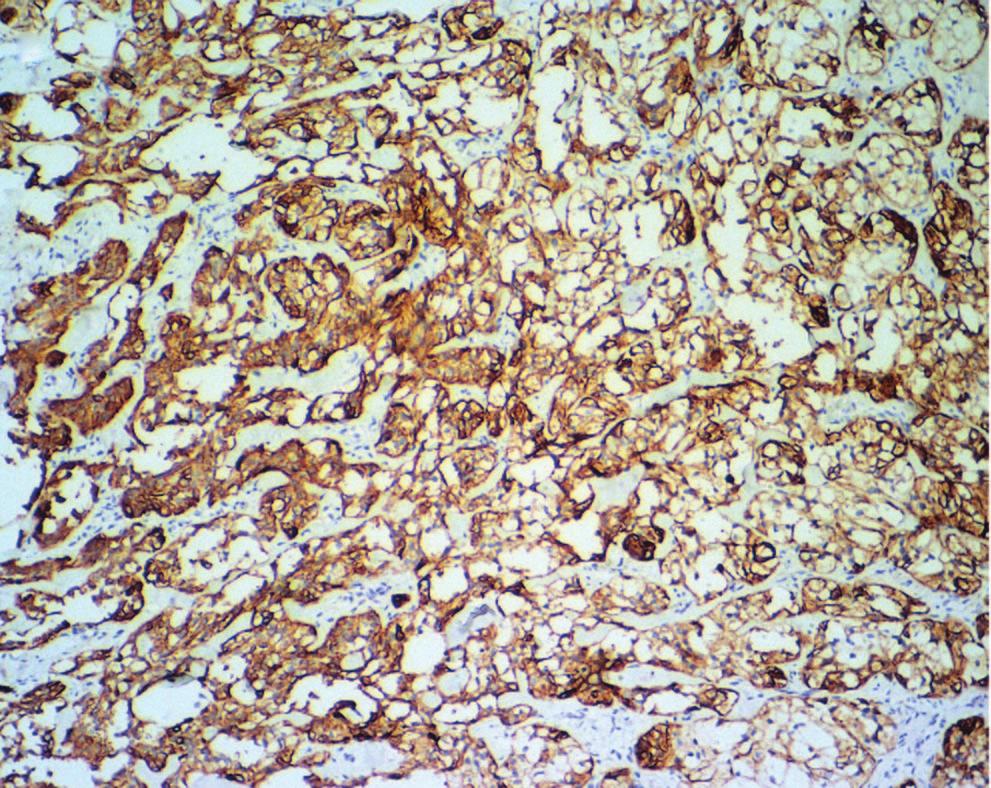 pttern contining n myloid-like mteril. In the current cse, reltively high proportion of the cler tumor cell components were oserved.