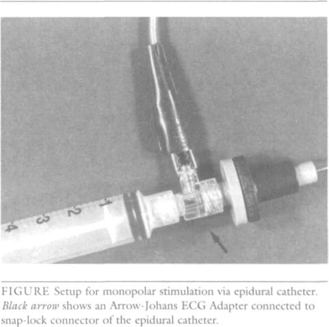 epidural space. Diagnosis of intravascular or subarachnoid catheter placement is usually one of exclusion using the standard epidural test dose (3 ml lidocaine 1.5% with 1:200,000 epinephrine).