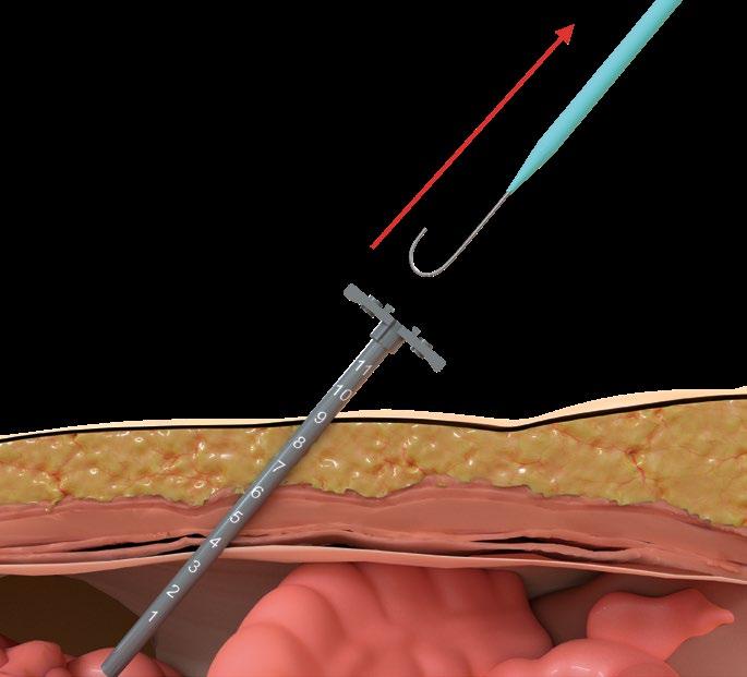 Catheter tip insertion: 8 (Image 8) Insert the tear away introducer/dilator assembly over the wire: Hold the