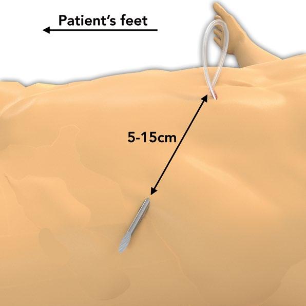 Tunneling: Once the catheter tip has been properly placed in the peritoneum, the next step is to create the tunnel: 12.