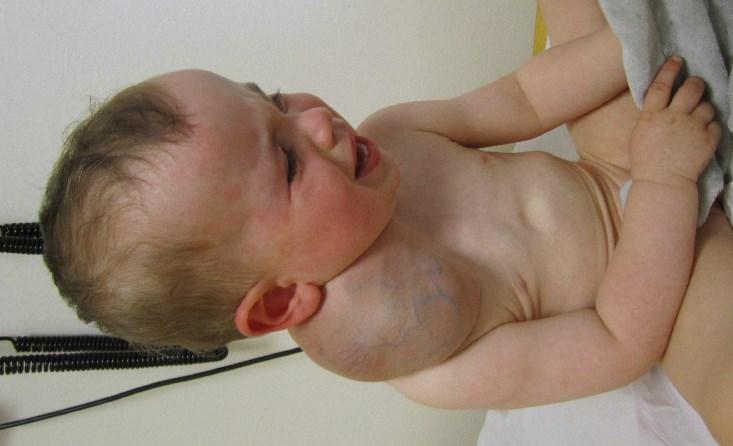 A B C Enfant de 14 mois présentant une masse cervicale