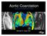 Aortic Coarctation Imaging and Management in Adults. Michael D. Hope, MD