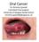 Oral Cancer Dr Christine Goodall Consultant Oral Surgeon University of Glasgow Dental School