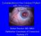 Considerations in the Cataract Patient with Glaucoma. Robert Noecker, MD, MBA Ophthalmic Consultants of Connecticut Fairfield, CT