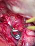 Cerebral aneurysm is the common term for an intracranial, Surgical Clipping for a Cerebral Aneurysm