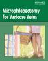 Microphlebectomy for Varicose Veins