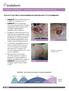 CLINICAL EVIDENCE Treatment of Venous Leg Ulcers (VLUs)