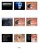 Lumps Bumps and Magic Potions Review of Ocular Tumors Ocular Tumors Eyelids Conjunctiva Intraocular Orbit