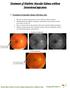 Treatment of Diabetic Macular Edema without Intravitreal injections