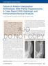 AJO. Failure of Artelon Interposition Arthroplasty After Partial Trapeziectomy: A Case Report With Histologic and Immunohistochemical Analysis