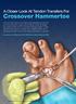 A Closer Look At Tendon Transfers For. Crossover Hammertoe