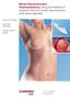 Breast Reconstruction Postmastectomy. Using DermaMatrix Acellular Dermis in breast reconstruction with tissue expander.