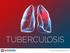 Symptoms Latent TB Active TB
