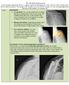 ANATOMIC TOTAL SHOULDER REPLACEMENT: